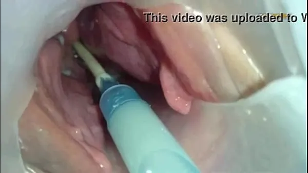 XXX Sperm injected into the uterus of the wife of others toplo tube
